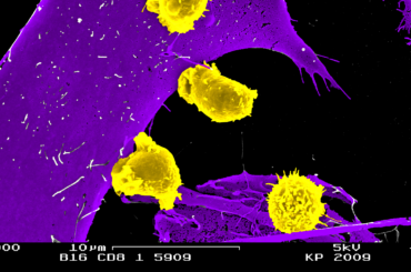 CD8 T cells (in yellow) attacks tumor cel