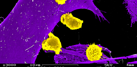 CD8 T cells (in yellow) attacks tumor cel